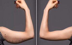 lifting non chirurgico delle braccia endolift laser