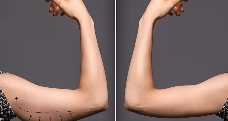 lifting non chirurgico delle braccia endolift laser