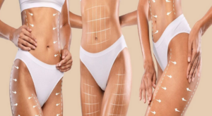 Addominoplastica laser costo