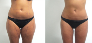 aumentare il volume dei glutei