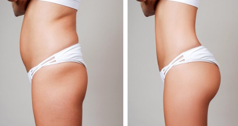 trattamenti chirurgici per aumentare il volume dei glutei