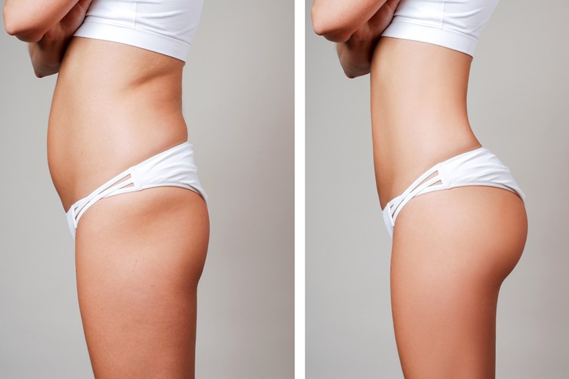 trattamenti chirurgici per aumentare il volume dei glutei
