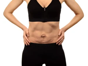 Arm lift after weight loss