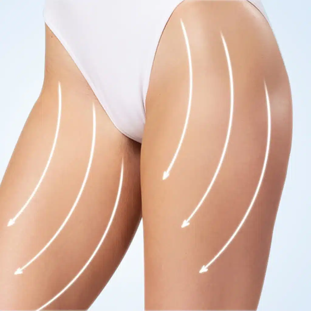 Liposuzione per lipedema costo