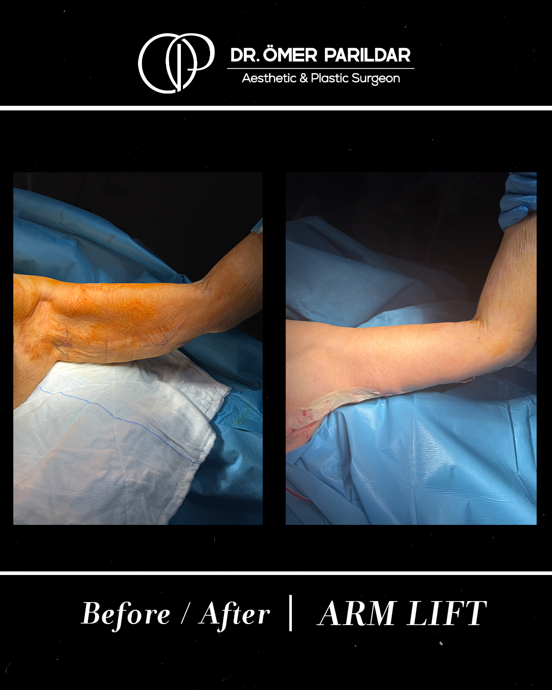 Lifting braccia prima e dopo