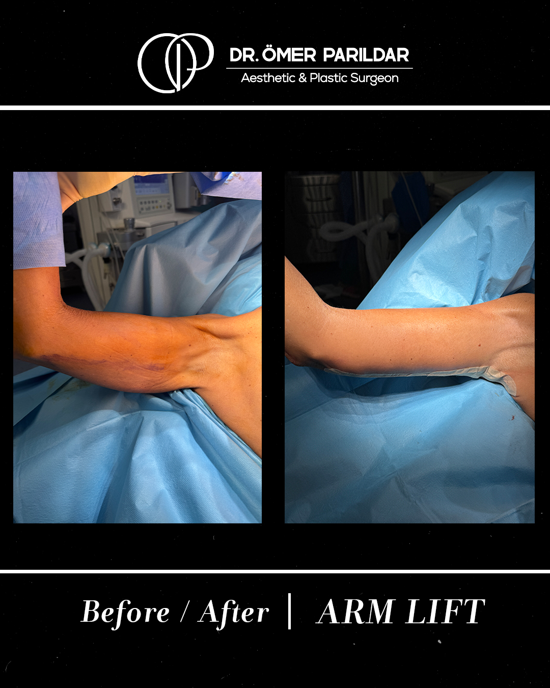 Lifting braccia prima e dopo