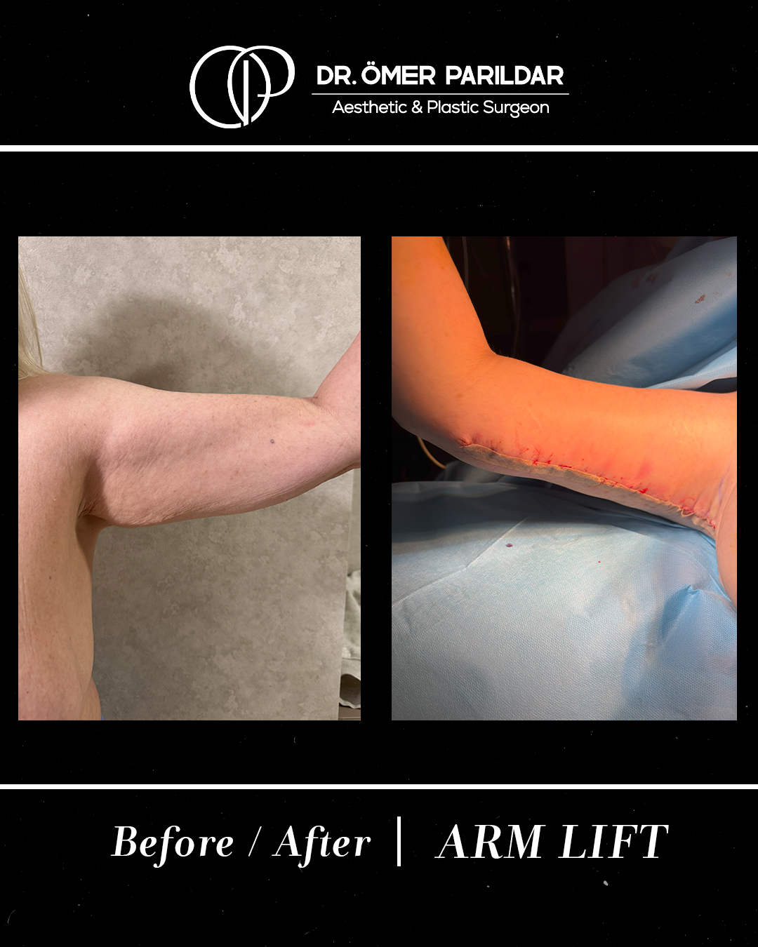 Lifting braccia prima e dopo