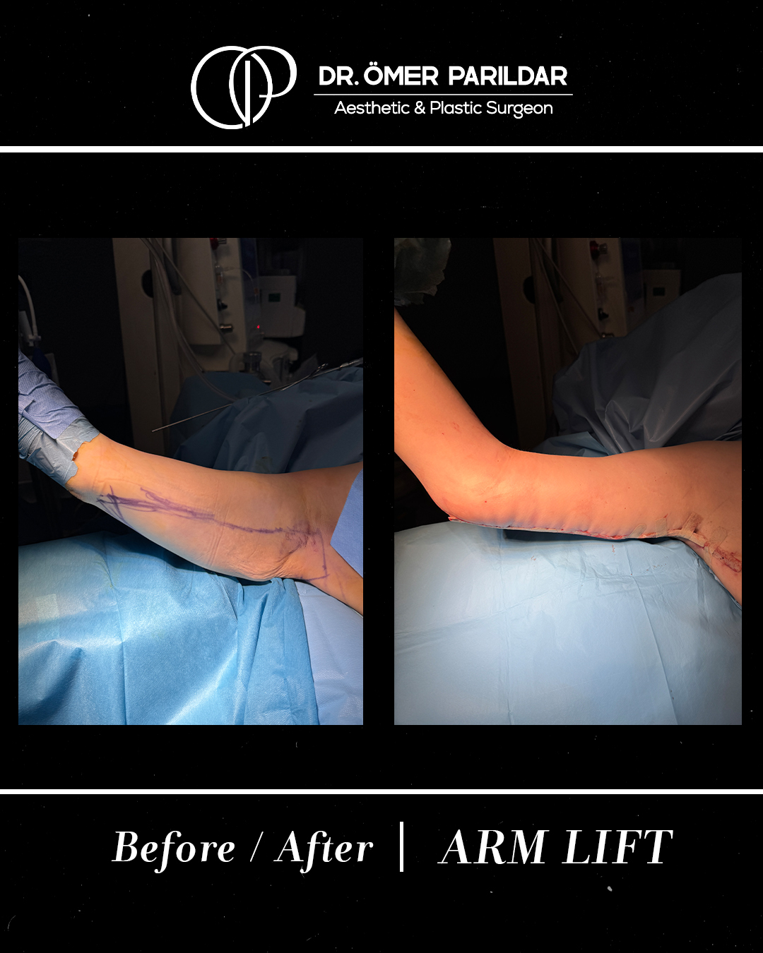 Lifting braccia prima e dopo