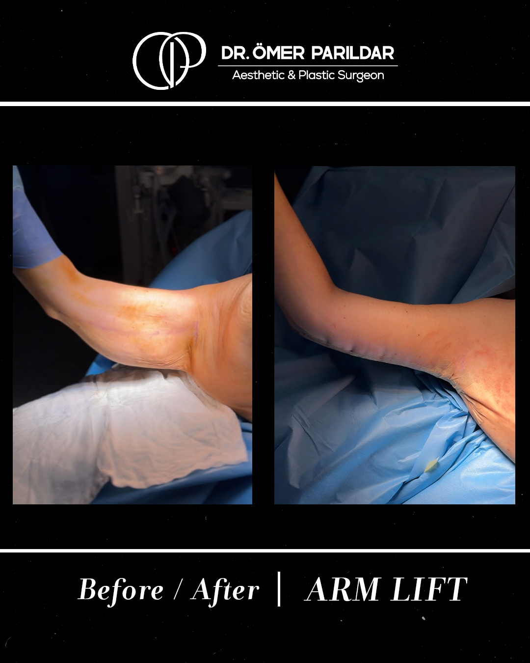 Lifting braccia prima e dopo