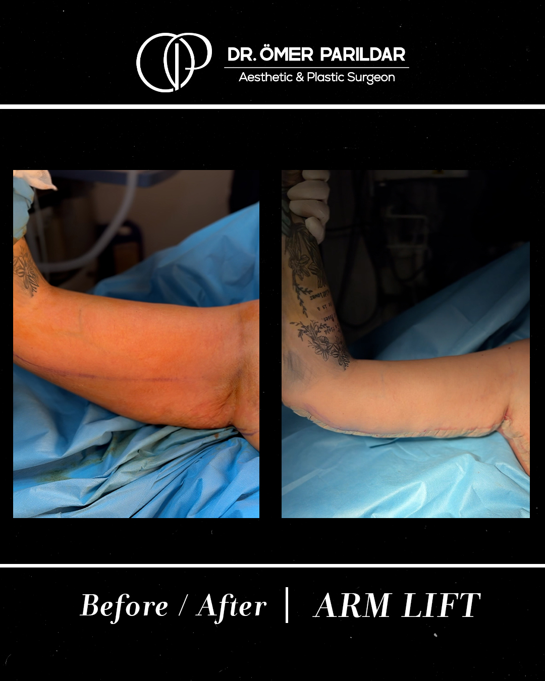Lifting braccia prima e dopo