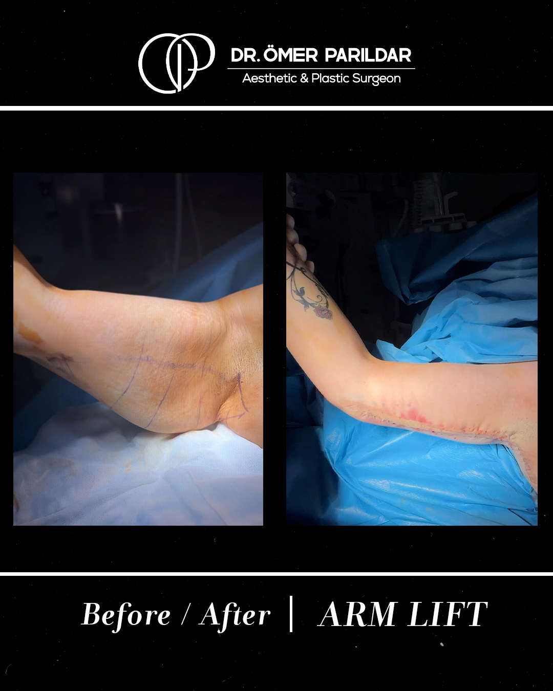 Lifting braccia prima e dopo