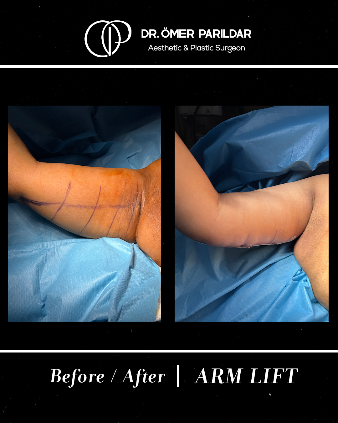 Lifting braccia prima e dopo