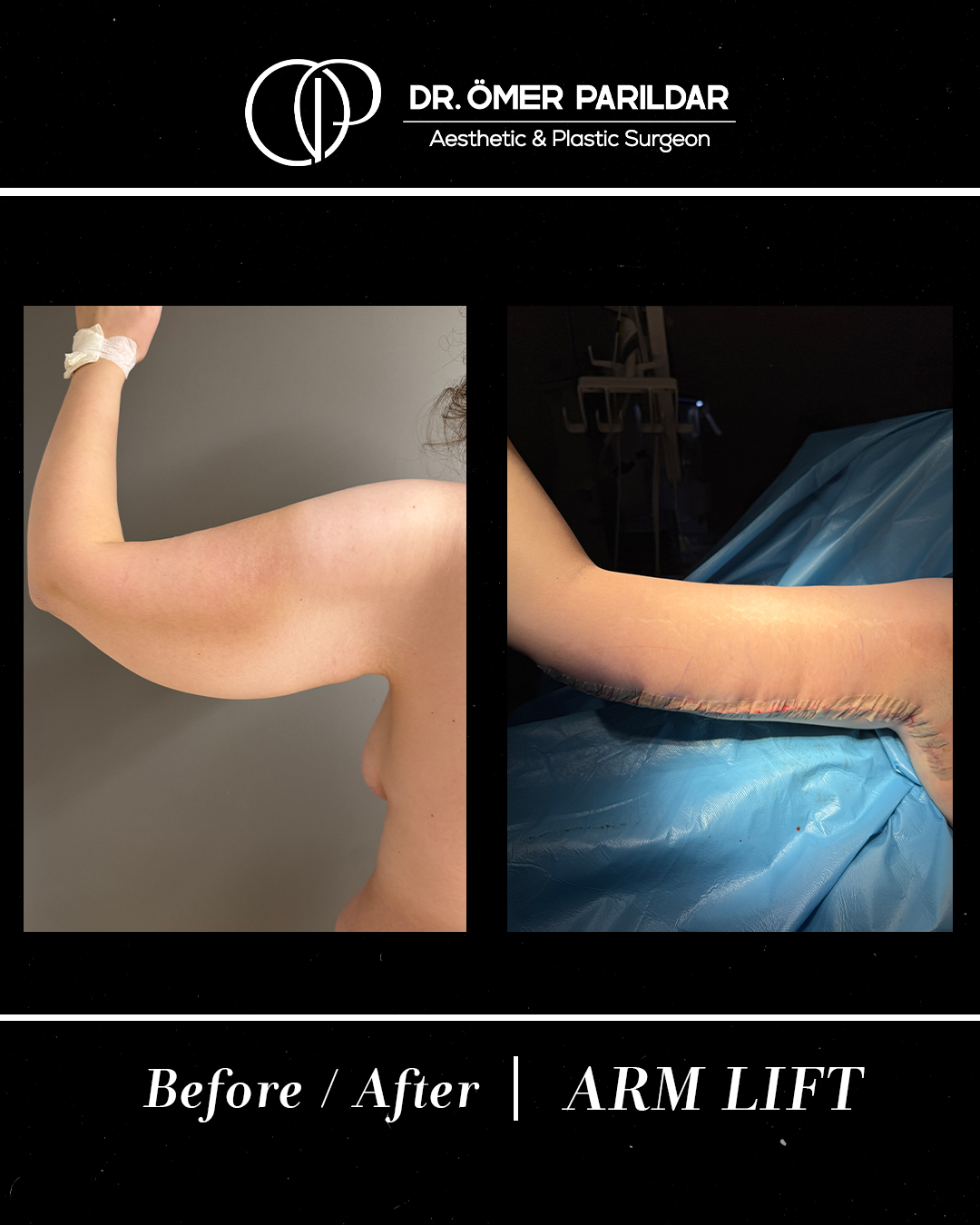 Lifting braccia prima e dopo