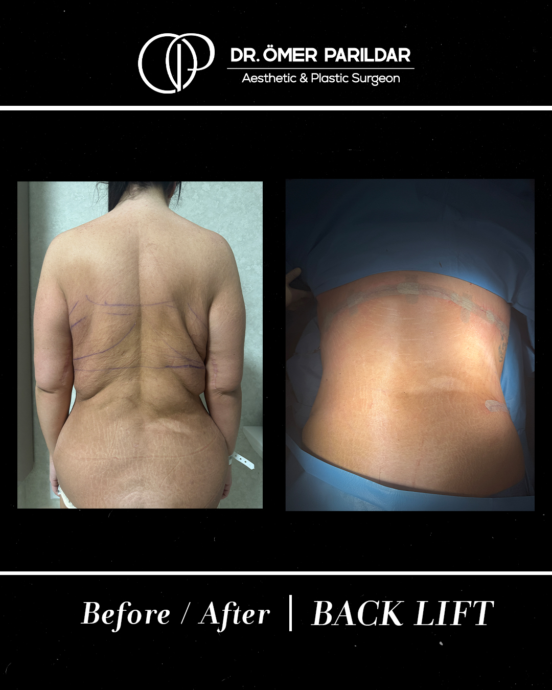 Back lift prima e dopo