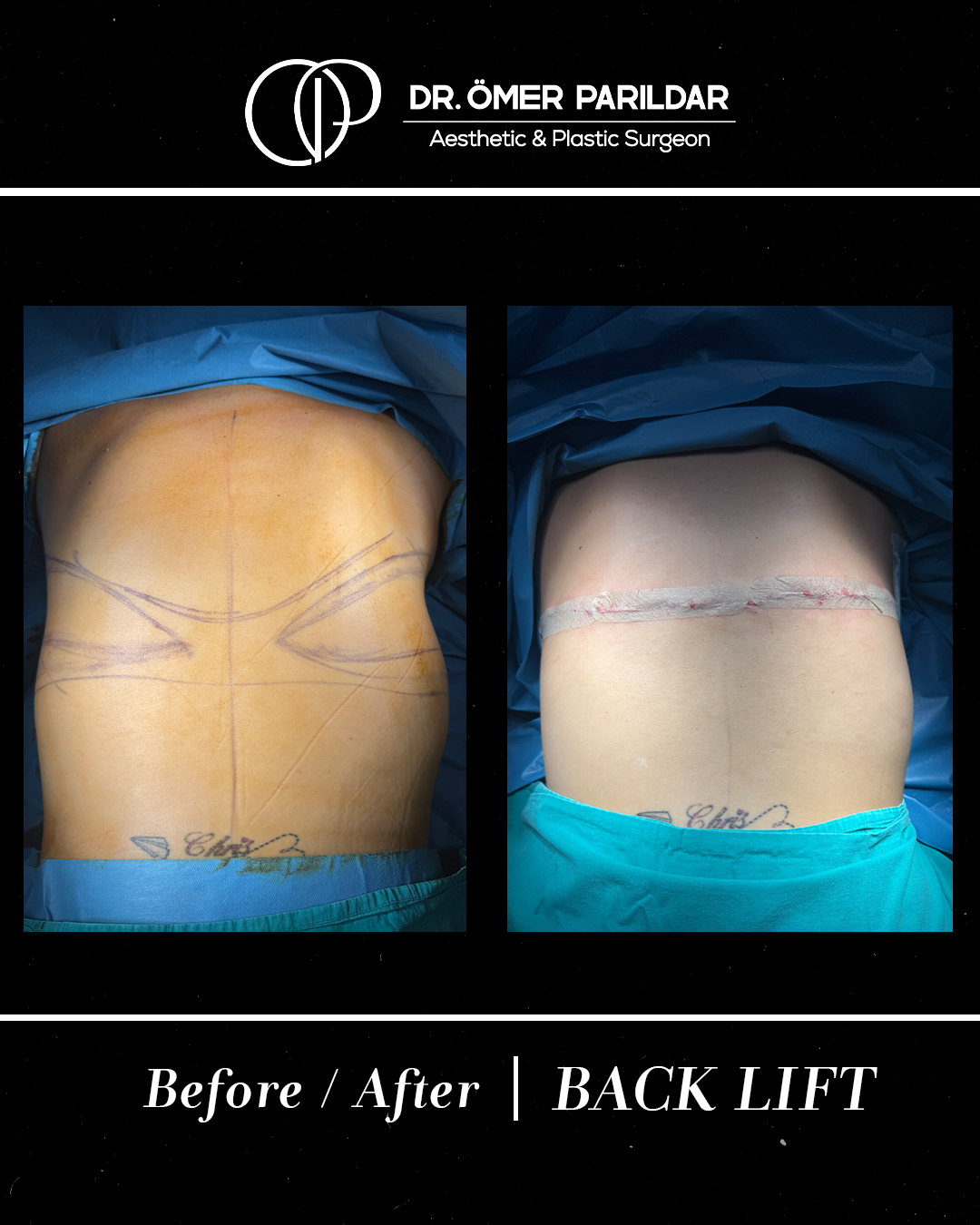 Back lift prima e dopo