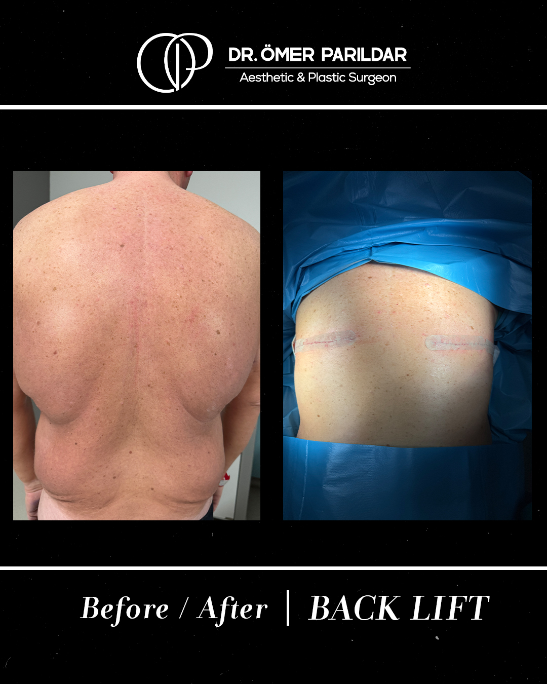 Back lift prima e dopo