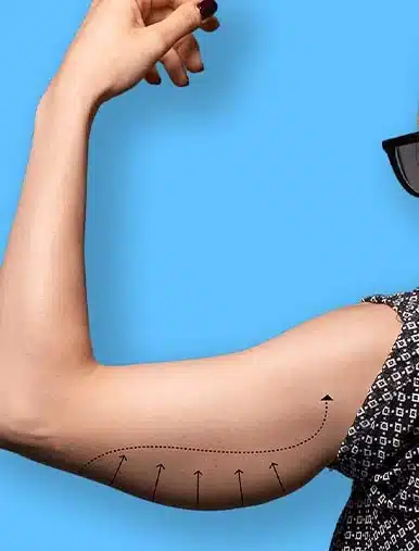 Lifting delle braccia con laser
