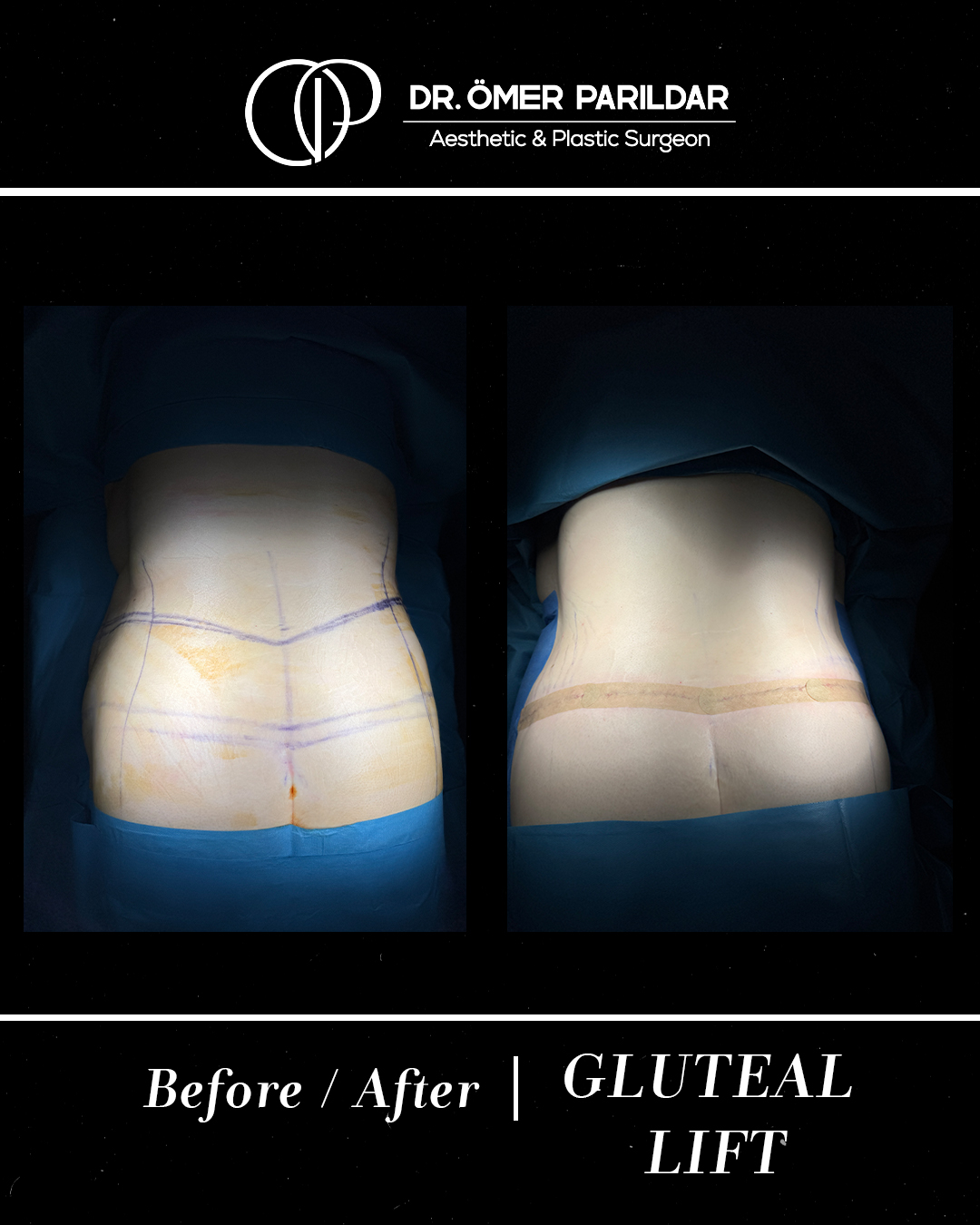 Lifting glutei prima e dopo