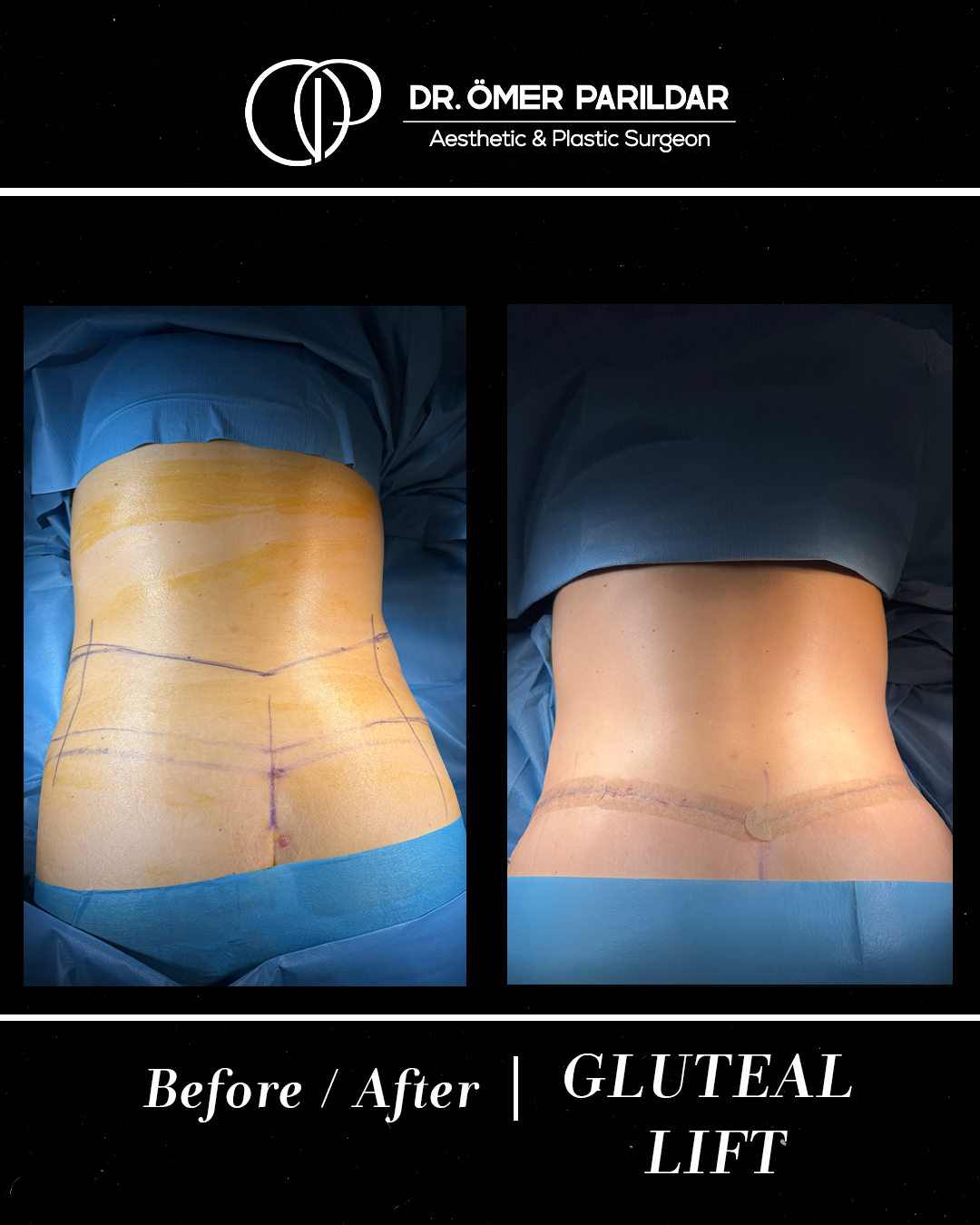 Lifting glutei prima e dopo