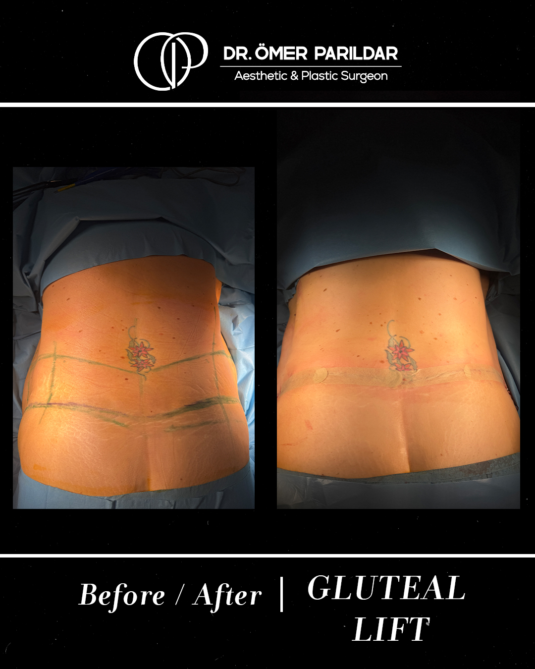 Lifting glutei prima e dopo
