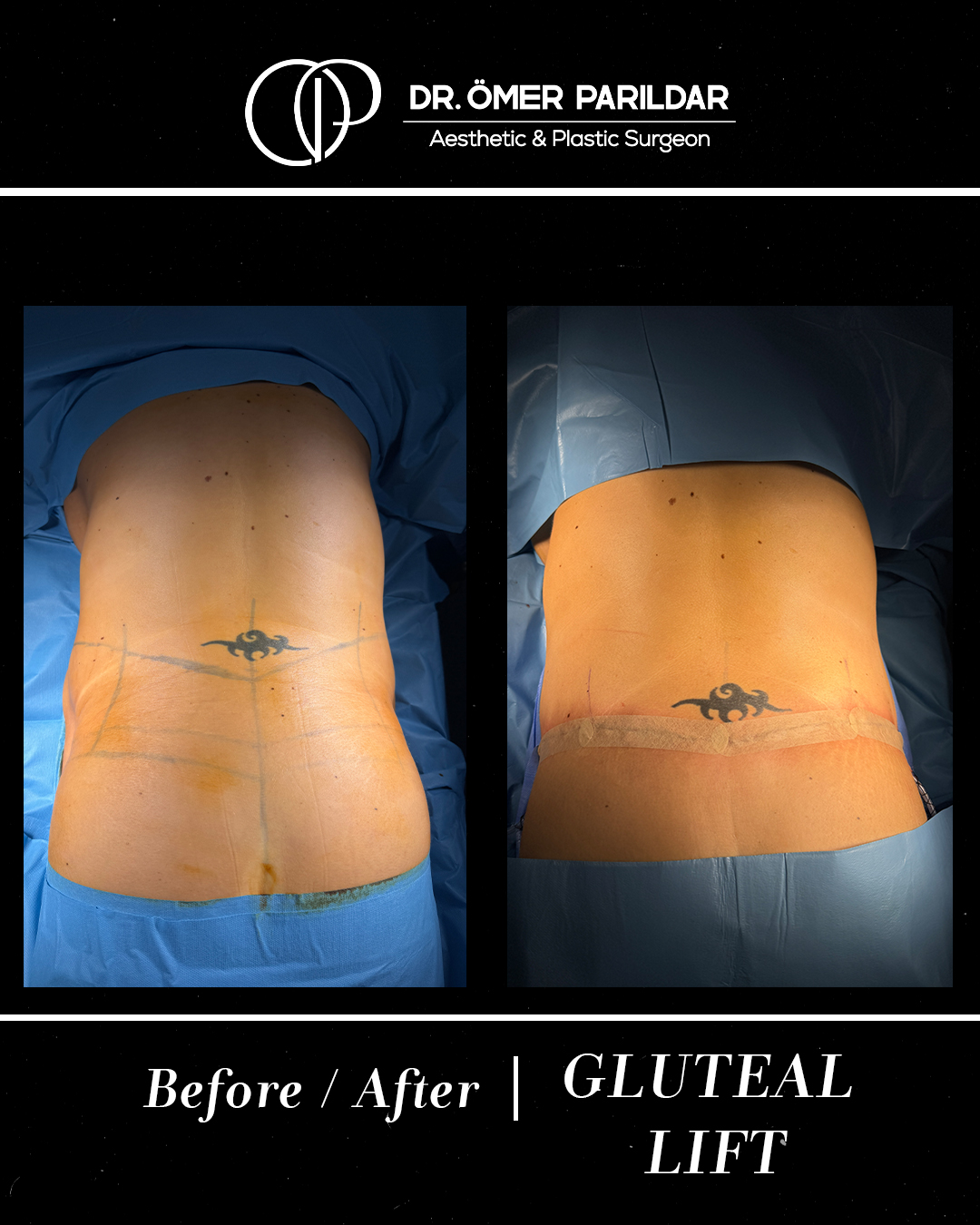 Lifting glutei prima e dopo