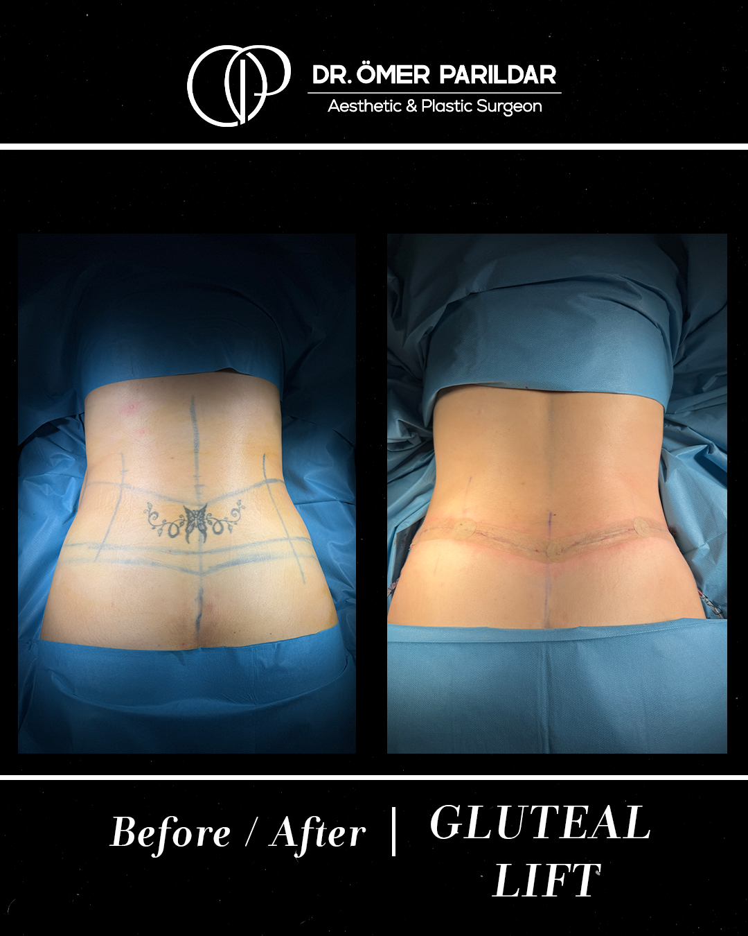 Lifting glutei prima e dopo