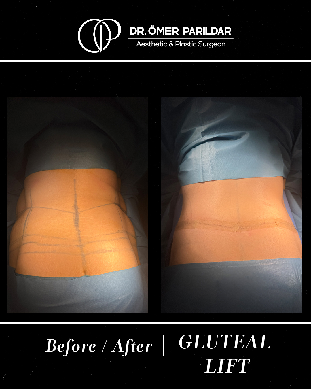 Lifting glutei prima e dopo