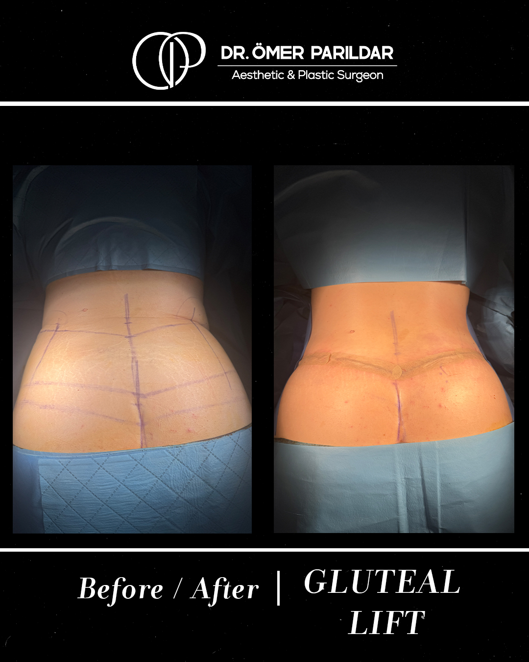 Lifting glutei prima e dopo
