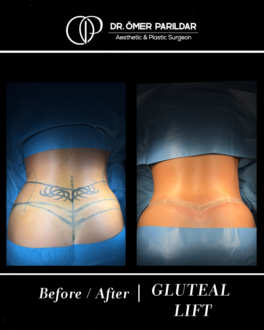 Lifting glutei prima e dopo
