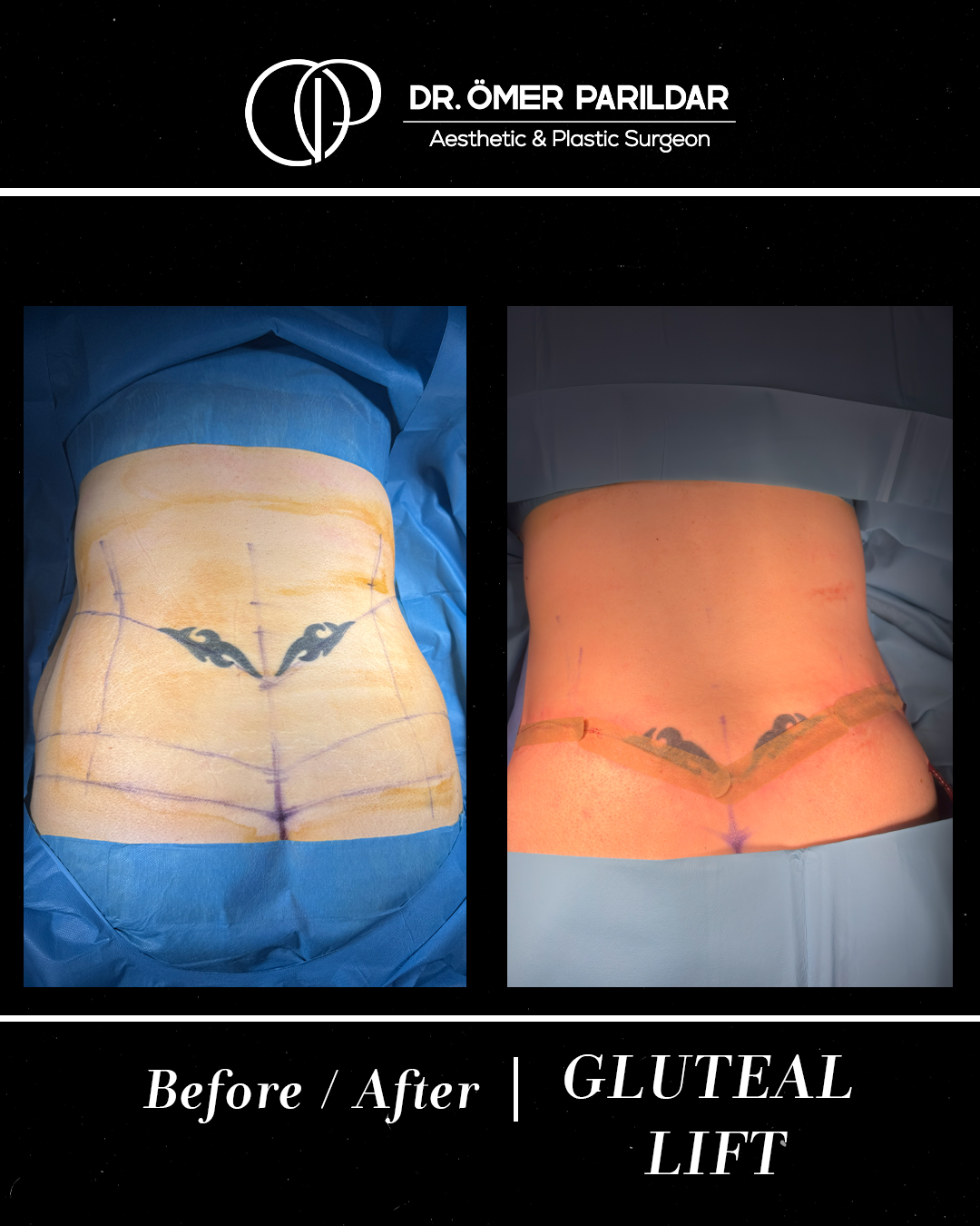 Lifting glutei prima e dopo