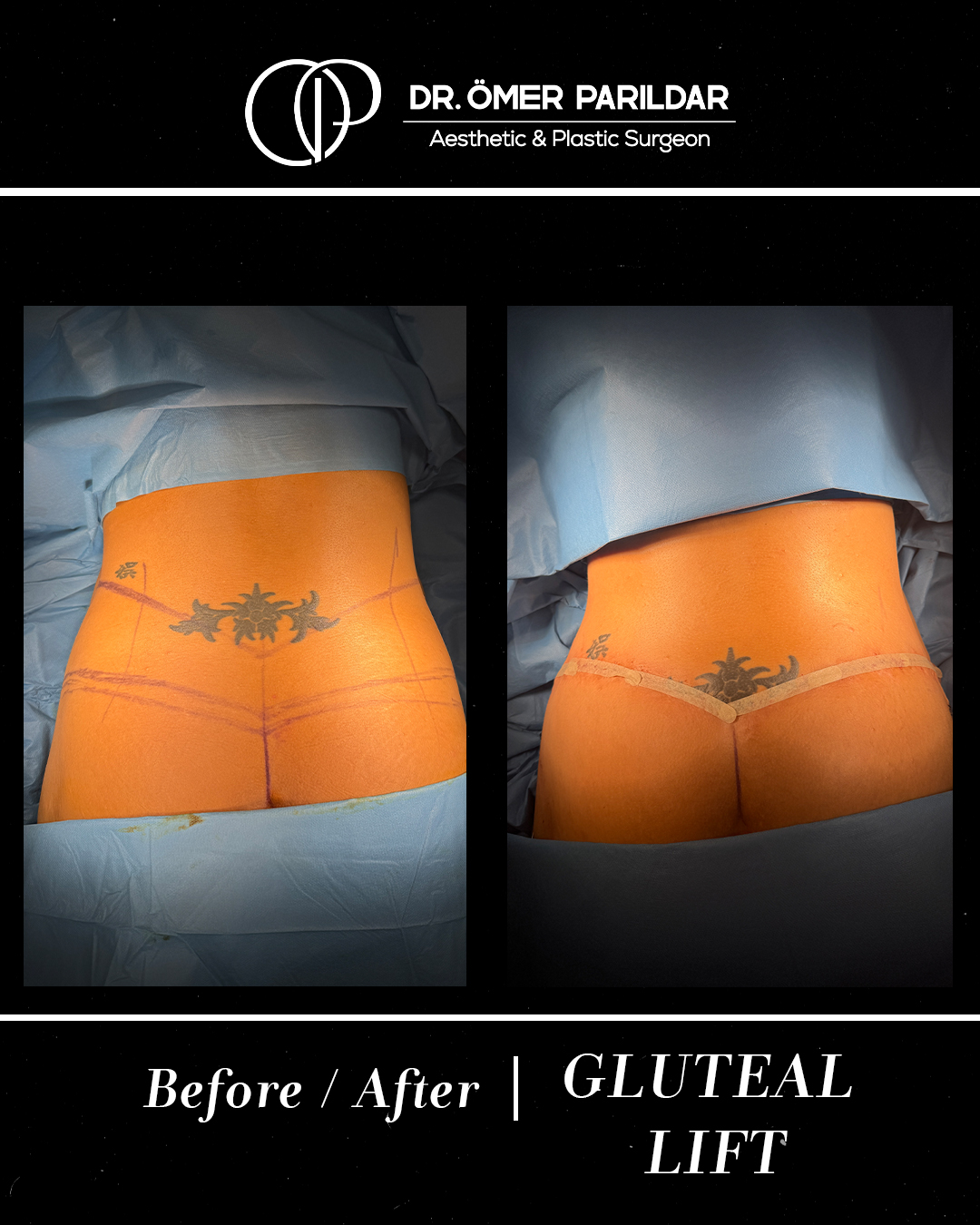 Lifting glutei prima e dopo