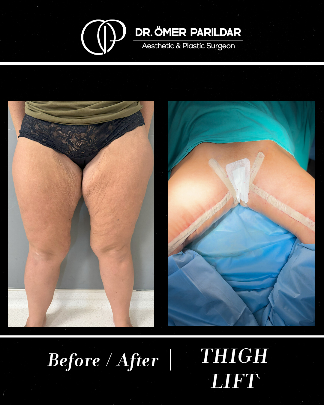 Risultato prima e dopo lifting cosce