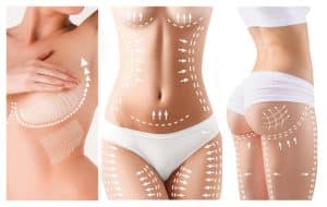 360 derece liposuction