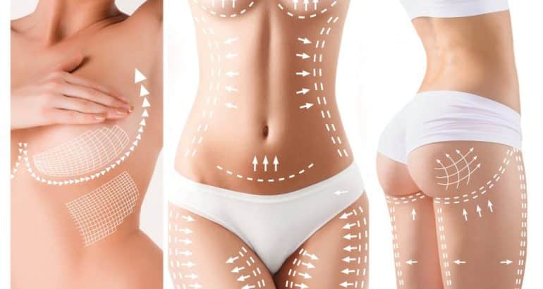 Tummy tuck after bariatric surgery