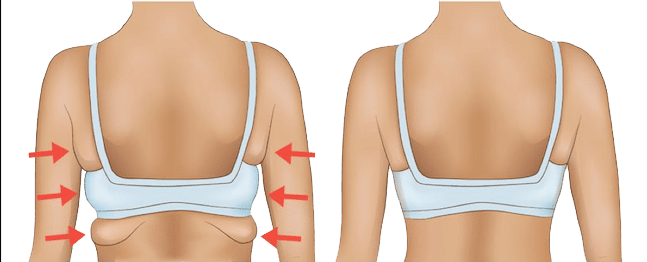 Lifting della Schiena (Back Lift)