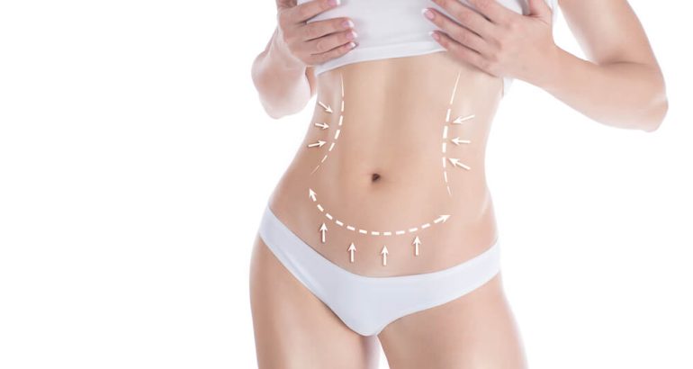 Liposuction ameliyatı