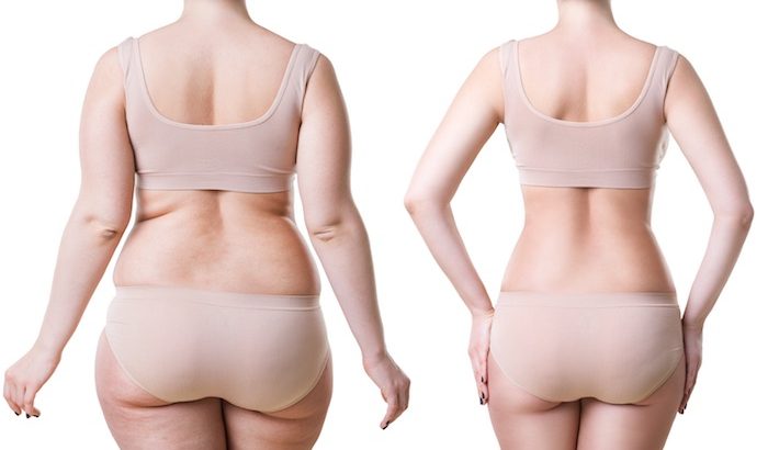 Liposuction surgery