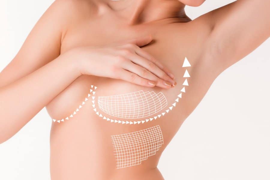 Breast implant replacement