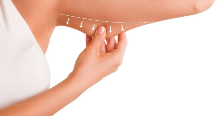 Lifting delle braccia con laser