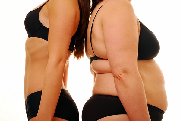 Tummy tuck surgery