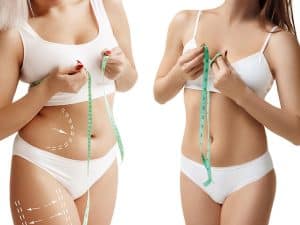 Tummy tuck surgery